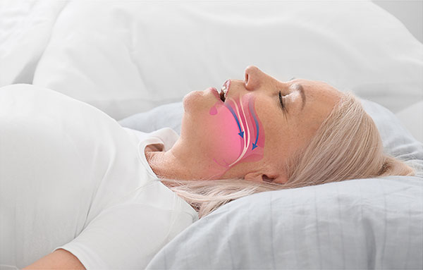woman with sleep apnea